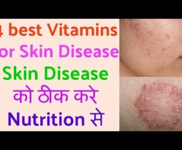 Skin Disease को ठीक करे Nutrition से | 4 best vitamin for skin disease Hindi