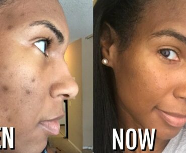 DARK SPOT ROUTINE| HOW TO REMOVE DARK SPOTS ON FACE| VITAMIN C