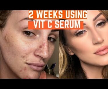 I USED VITAMIN C SERUM ON MY DARK SPOTS  FOR 2 WEEKS & THIS HAPPENED