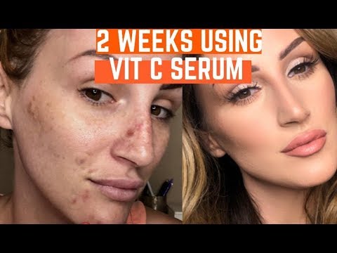 I USED VITAMIN C SERUM ON MY DARK SPOTS  FOR 2 WEEKS & THIS HAPPENED