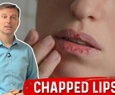 Which Vitamin Deficiency Causes Chapped / Cracked Lips ?