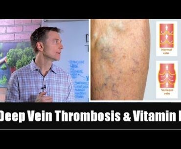 Deep Vein Thrombosis (Blood Clot in Legs) & Vitamin E