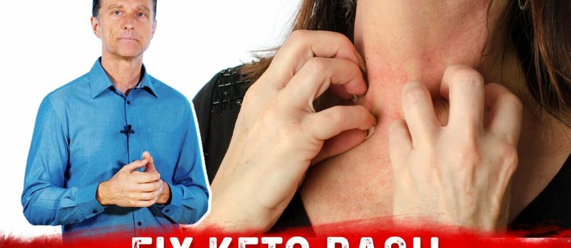 Keto Rash is a Vitamin B2 (Riboflavin) Deficiency