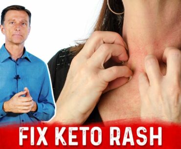 Keto Rash is a Vitamin B2 (Riboflavin) Deficiency