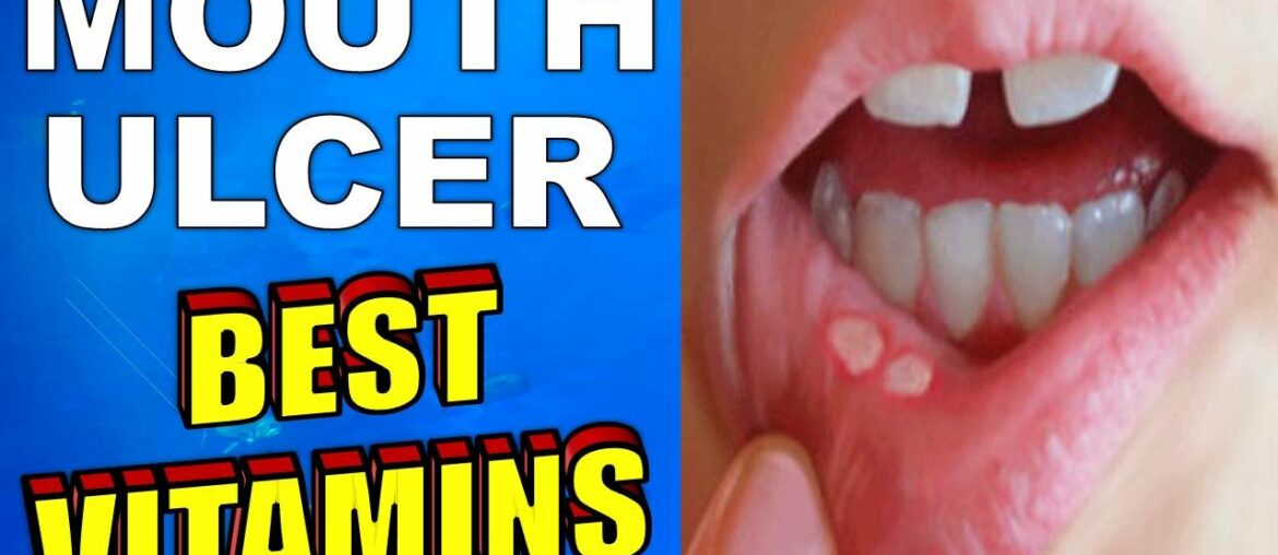 What is the BEST VITAMIN for MOUTH ULCERS