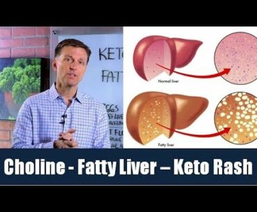 Choline is the Vitamin for a Fatty Liver & Can Prevent Keto Rash