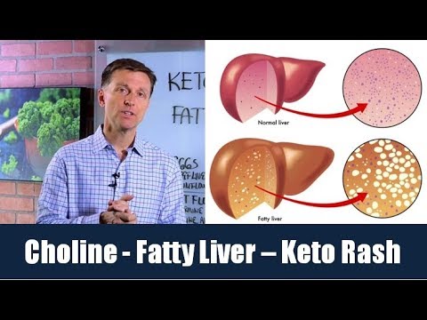 Choline is the Vitamin for a Fatty Liver & Can Prevent Keto Rash