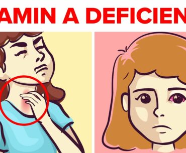 5 Hidden Signs Of Vitamin A Deficiency You Should Not Ignore