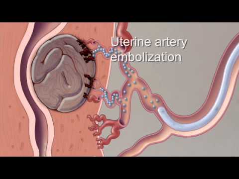Fibroid Treatment Options - Mayo Clinic