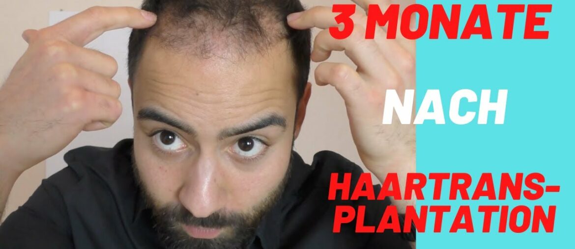 3 Monate nach Haartransplantation in Istanbul, Friseur besuch, Fitness, Nahrungsergänzungsmittel