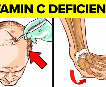 Vitamin C Deficiency Symptoms That Should Never Be Ignored