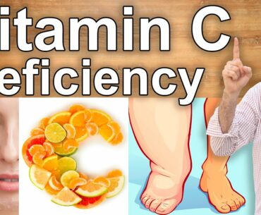 YOUR BODY IS SCREAMING IN NEED FOR VITAMIN C - Vitamin C Deficiency Symptoms and Its Benefits