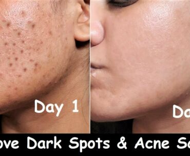 In 7 DAYS - Remove DARK SPOTS, BLACK SPOTS & ACNE SCARS | Orange juice Vitamin C Toner | Open Pores