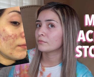 MY BIGGEST INSECURITY (my acne story)