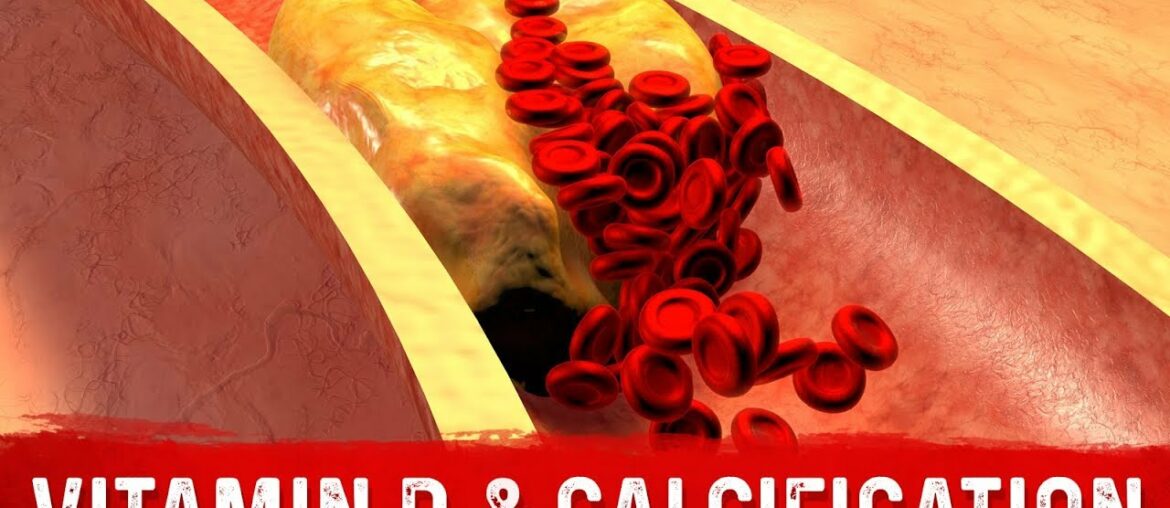 Vitamin D and Coronary Artery Calcification