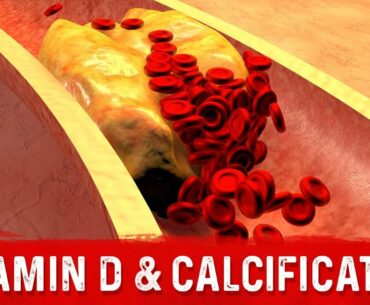 Vitamin D and Coronary Artery Calcification