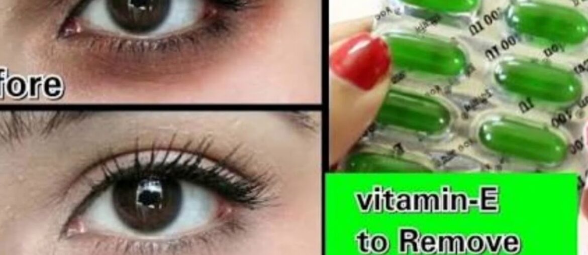 How to remove Dark circles naturally with VITAMIN-E and ALOE VERA (100%) results ( हिन्दी मे)