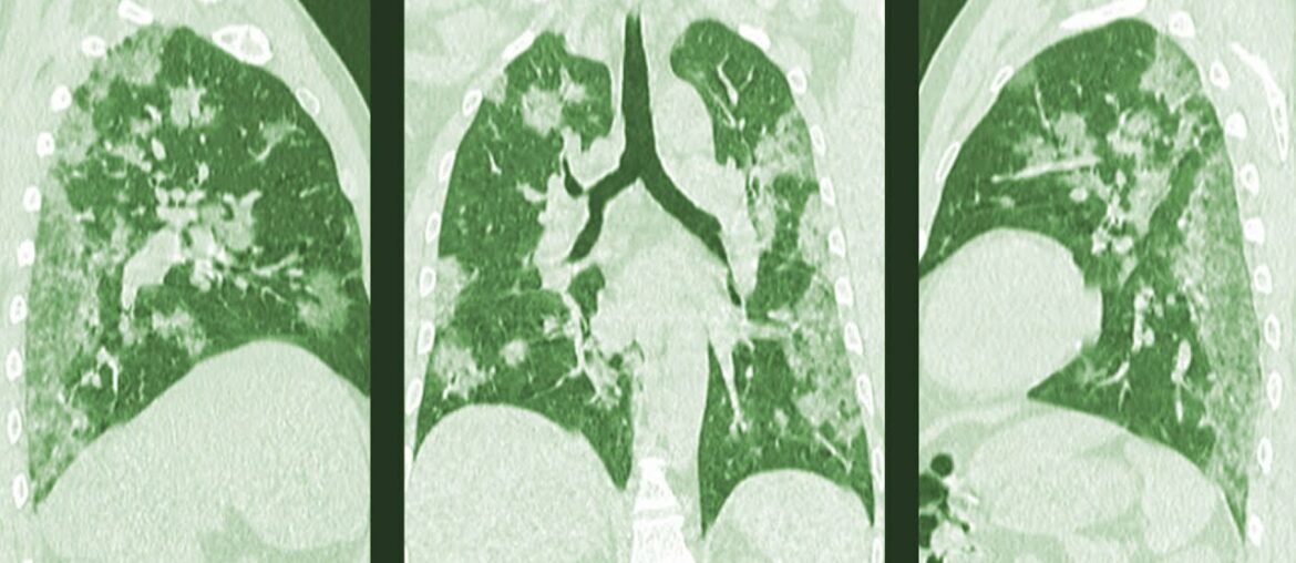 3 COVID-19 Cases As Described By Doctors In China