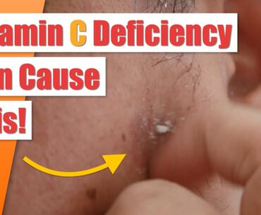 Vitamin C Deficiency Symptoms and How to Treat Them