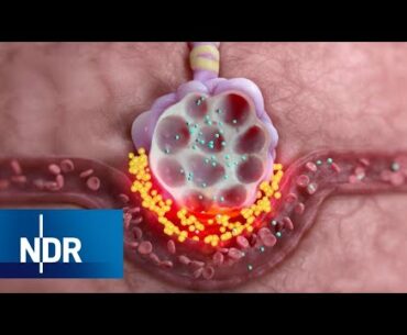 Coronavirus: So verläuft die Erkrankung Covid-19 | Visite | NDR