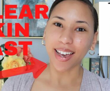 HOW TO GET RID OF ACNE IN ONE DAY| How to Get Clear Skin Instantly| Glowy Skin| Clear Skin Fast|