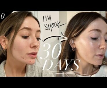 How I cleared my hormonal acne in 30 days | Supplements I take!