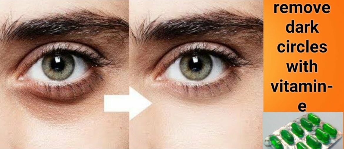 How to remove dark circles with vitamin - E ,  best treatment