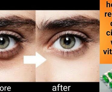 How to remove dark circles with vitamin - E ,  best treatment