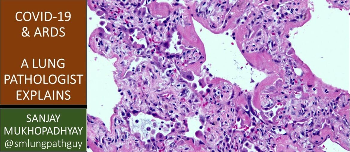 COVID-19 can kill: a lung pathologist explains what ARDS means and why it's important