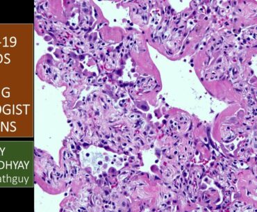 COVID-19 can kill: a lung pathologist explains what ARDS means and why it's important