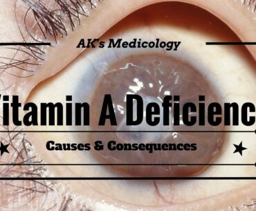 Vitamin A deficiency: Causes & Consequences | Dr. Akshay Kewlani