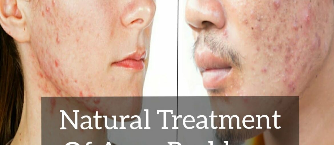 How to Cure Acne Problems | Natural Treatments Of Acne | (Natural Cures)