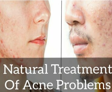 How to Cure Acne Problems | Natural Treatments Of Acne | (Natural Cures)