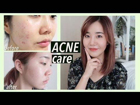 How I Got Rid of Acne Scars & Hyperpigmentation with Korean Skincare