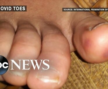 Doctors warn of mystery coronavirus symptom called 'COVID toes'