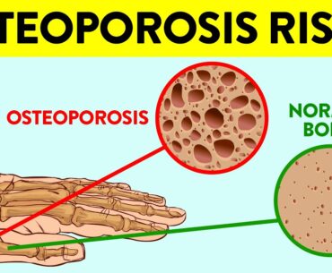 13 Early Warning Signs You’re At Risk For Osteoporosis