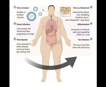 Coronavirus linked to greater risk of life threatening infection in people with obesity