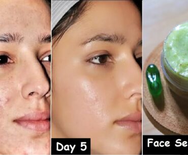 Doctors are SHOCKED! This Aloevera Face Gel Removes Dark Spots in 3 Days - Vitamin E Oil Skin Serum