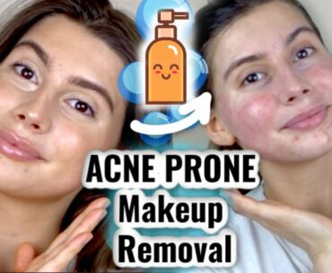 HOW I REMOVE MY MAKEUP FOR ACNE PRONE SKIN || 2 STEP PROCESS & sensitive skin friendly!!