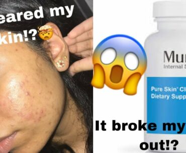 I TRIED THE MURAD PURE SKIN CLARIFYING DIETARY SUPPLEMENT FOR *ACNE* FOR 3 WEEKS AND..| megha kamath