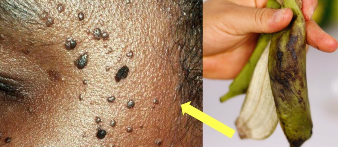 REMOVE SKIN TAGS & MOLES OVERNIGHT WITH BANANA PEEL ((TWO WAYS))