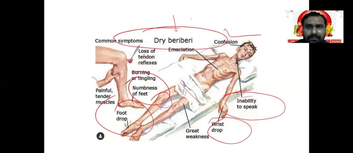 Vitamin B1 ( thiamine ) | Beriberi | Wernicke Korsakoff syndrome