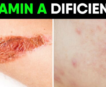 7 Hidden Signs of Vitamin A Deficiency You Should Not Ignore