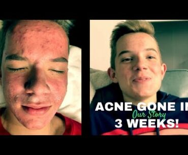 WHY DON'T DOCTORS KNOW THIS? MY SON'S ACNE HEALED!! (OUR STORY)