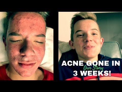 WHY DON'T DOCTORS KNOW THIS? MY SON'S ACNE HEALED!! (OUR STORY)