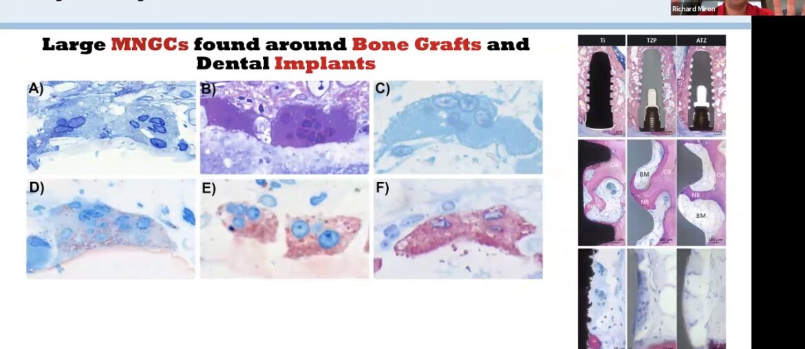 Vitamin D Deficiency and Dental Implant Failure by Dr. Richard Miron