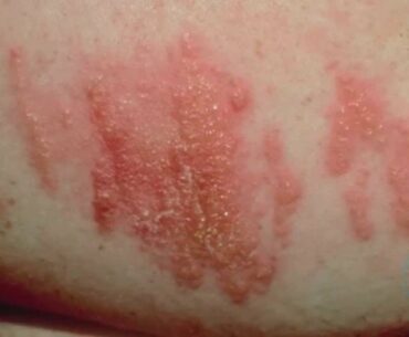 How to tell if a rash needs medical attention