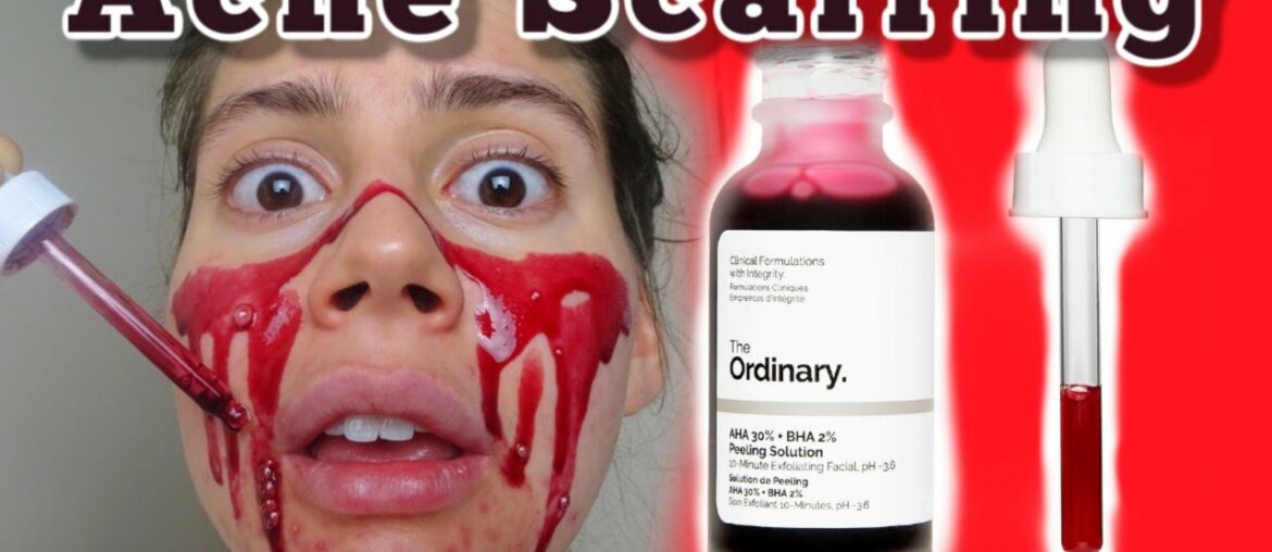 I TESTED THE ORDINARY PEELING SOLUTION FOR MY ACNE SCARS ONE MONTH LONG.. THIS IS THE FULL REVIEW