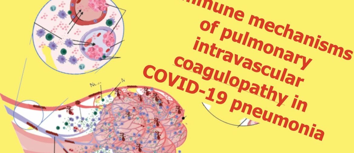 Immune mechanisms of pulmonary intravascularcoagulopathy in COVID-19 pneumonia