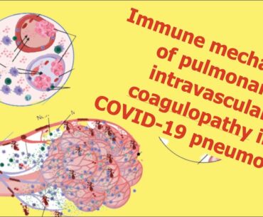 Immune mechanisms of pulmonary intravascularcoagulopathy in COVID-19 pneumonia